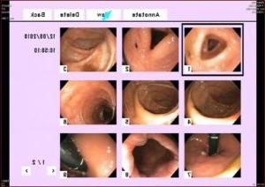 Endoscopy